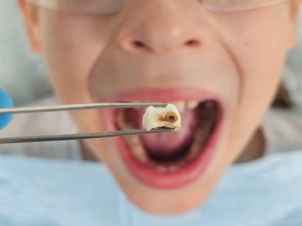 Best Broken or Cracked Tooth Emergency Dentist in Lake Cherokee, TX